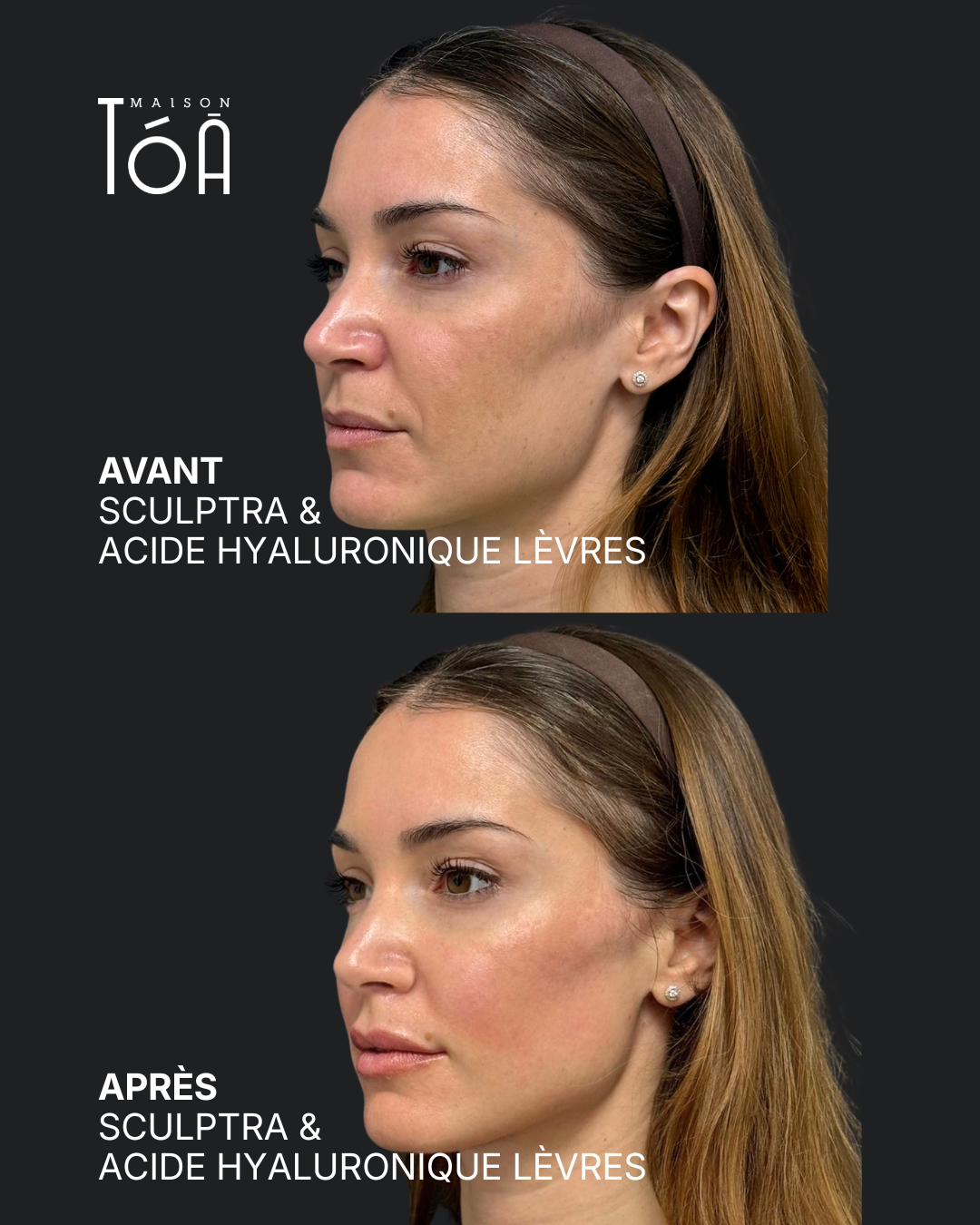 sculptra Après profhilo