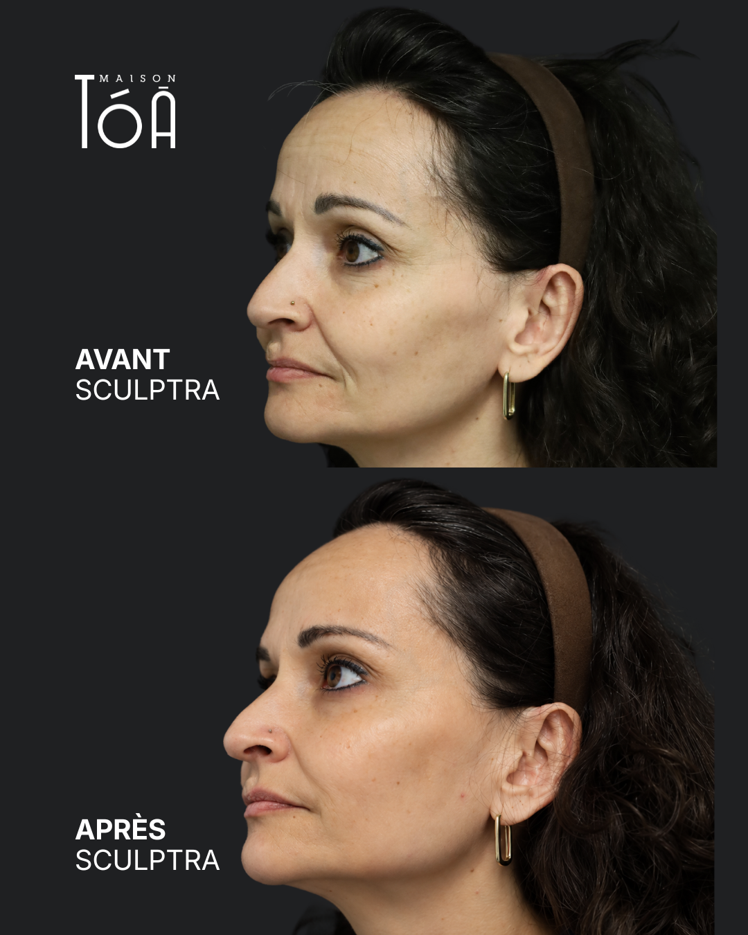 Avant Après sculptra