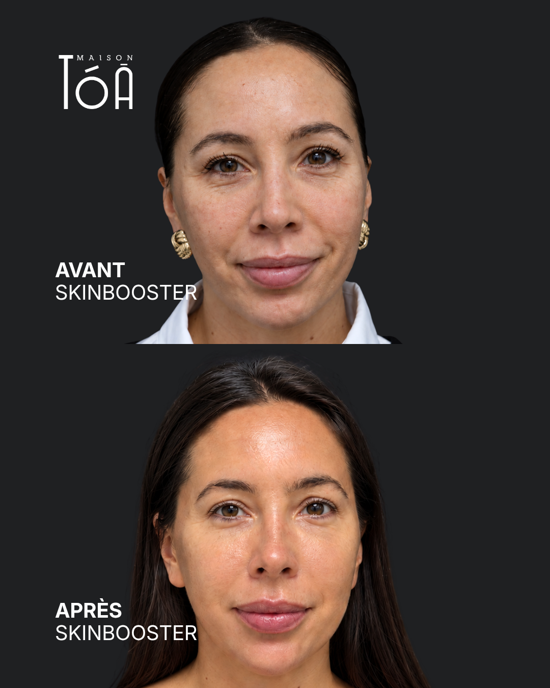 Skinbooster avant / après — cas 1, Maison Tóā Lausanne