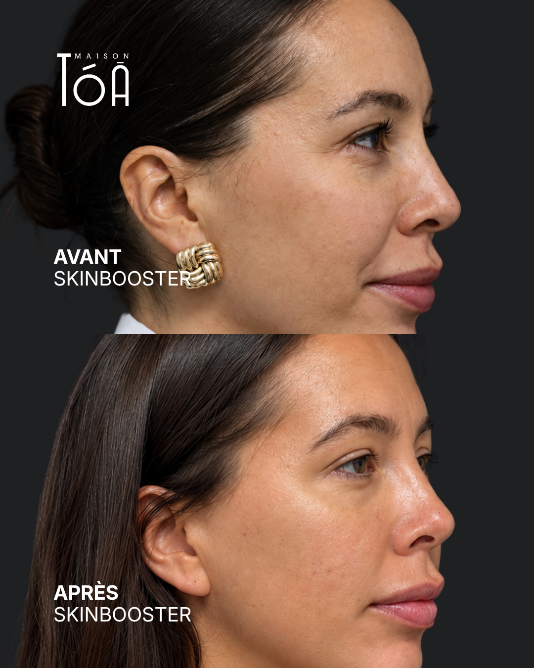 Skinbooster avant / après — cas 2, Maison Tóā Lausanne