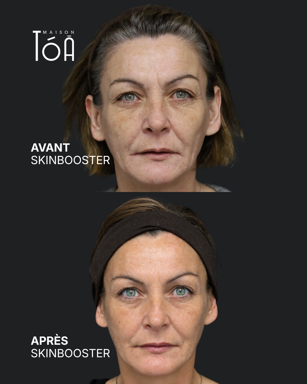 avant apres skinbooster 5