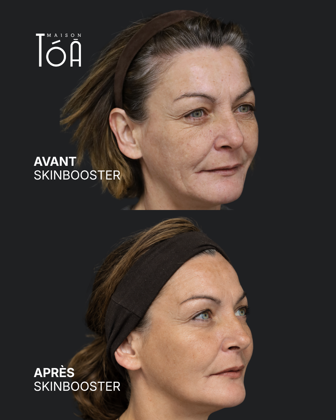 avant apres skinbooster 7