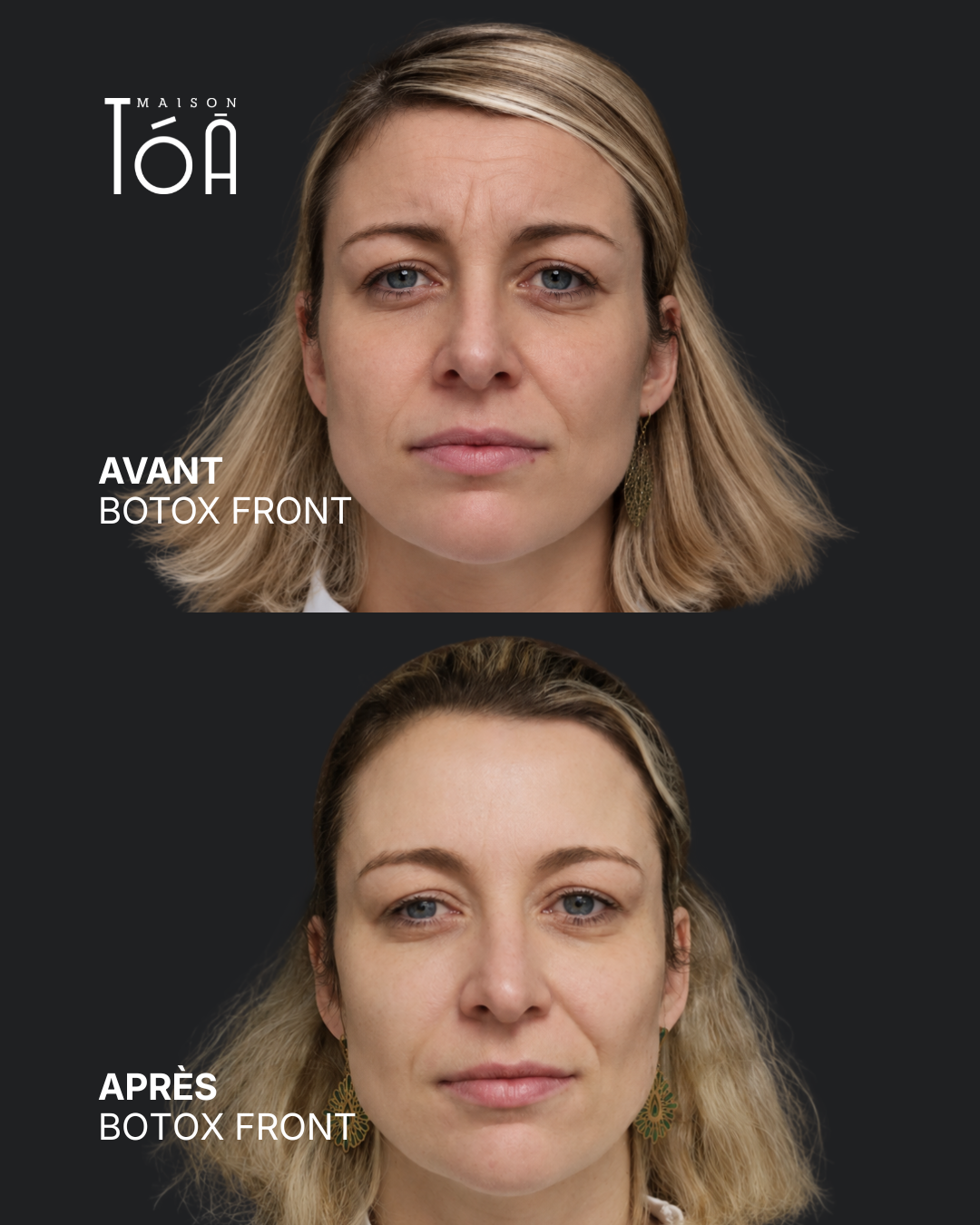 Botox 5 Avant/après toxine botulique, résultat 1, Maison Tóā Lausanne