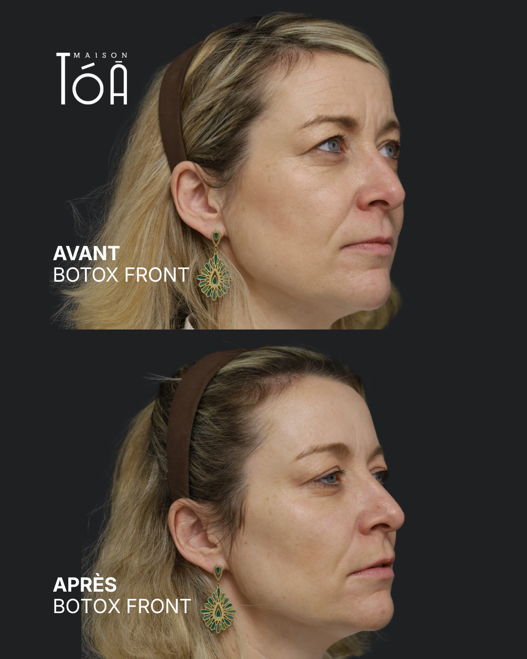 Botox 6 Avant/après toxine botulique, résultat 2, Maison Tóā Lausanne