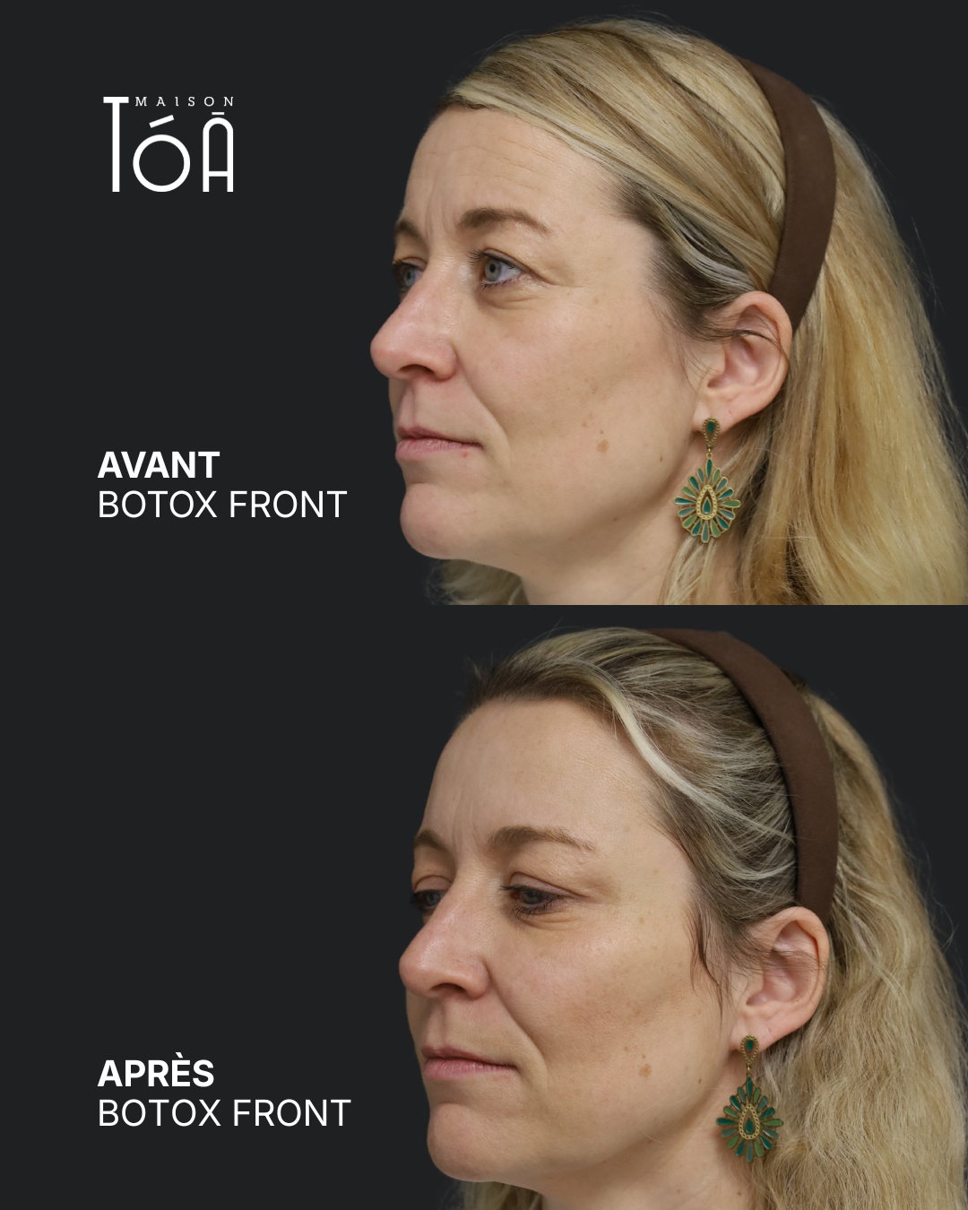 Botox 7 Avant/après toxine botulique, résultat 3, Maison Tóā Lausanne