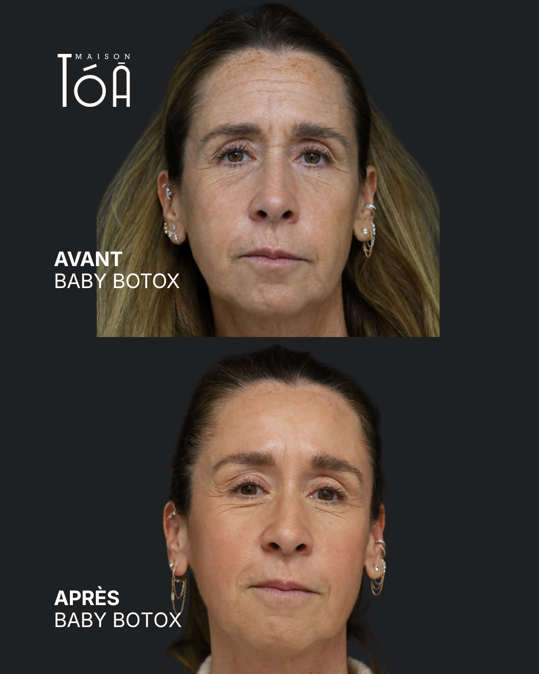 Botox 10 Avant/après toxine botulique, résultat 5, Maison Tóā Lausanne