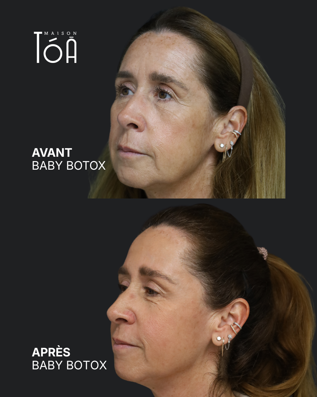Botox 9 Avant/après toxine botulique, résultat 6, Maison Tóā Lausanne