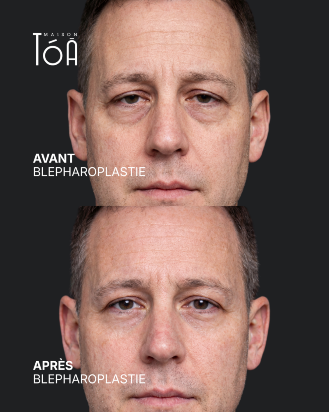 Blépharoplastie 6 Blépharoplastie avant après