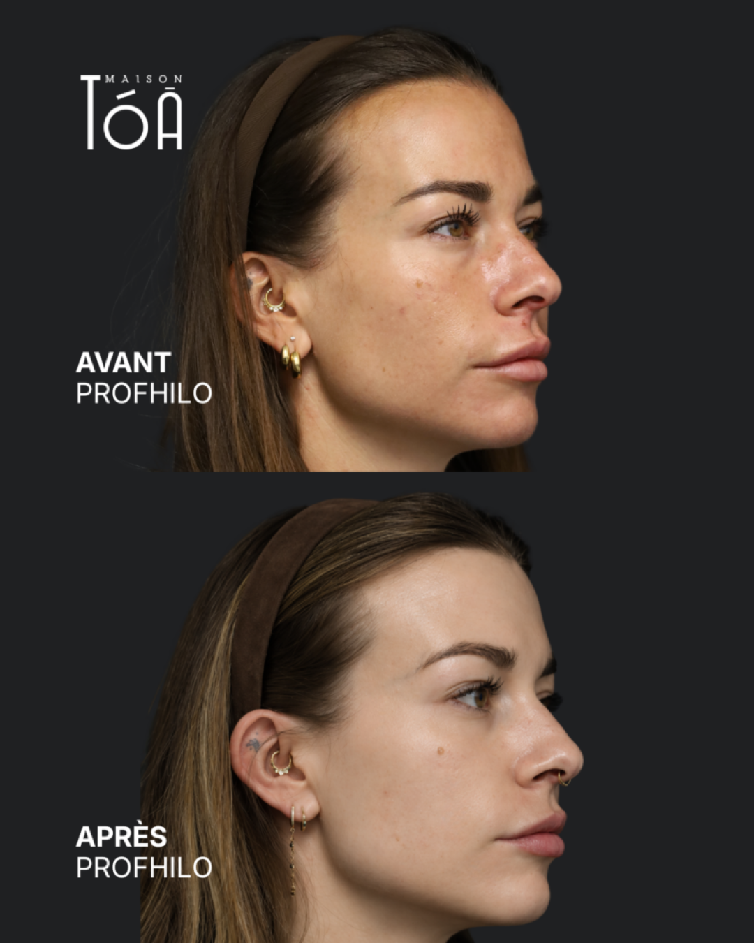 Profhilo® 6 Avant Après profhilo
