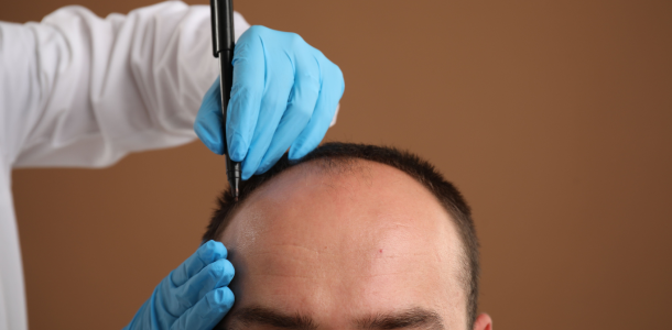 Implant capillaire a lausanne