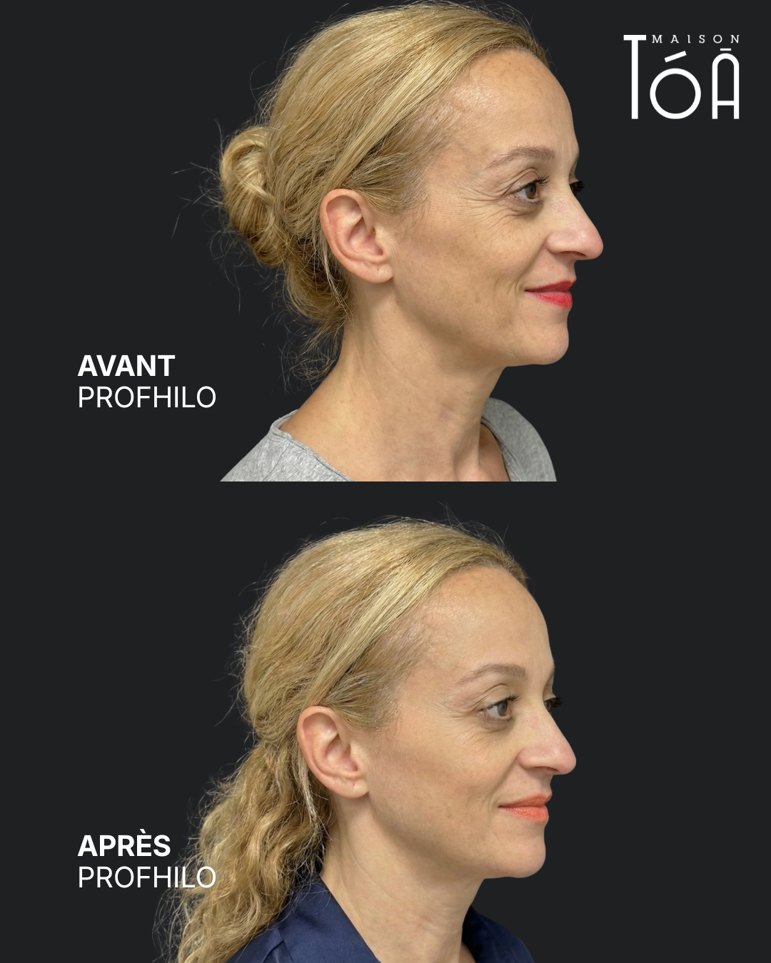 Avant Après profhilo 