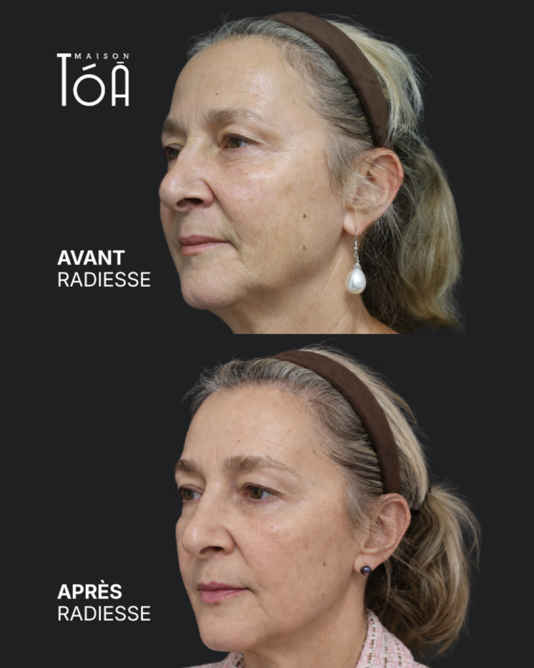 avant après radiesse