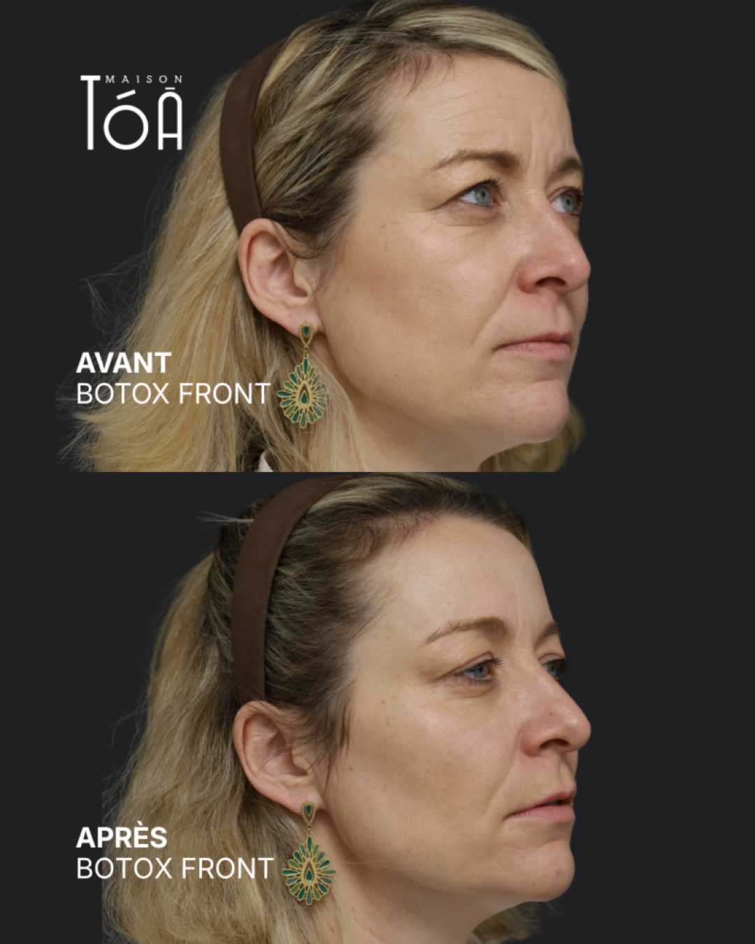 Botox 5 Avant/après toxine botulique, résultat 1, Maison Tóā Lausanne