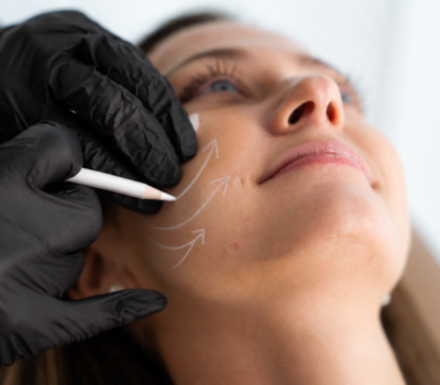 Marquage esthetique des lignes du visage e1791197023580