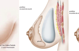 augmentation mammaire derrière le muscle