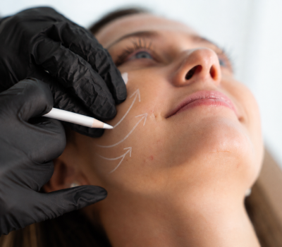 Lipofilling mammaire 5 Marquage esthetique des lignes du visage