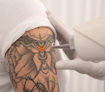 Laser Détatouage