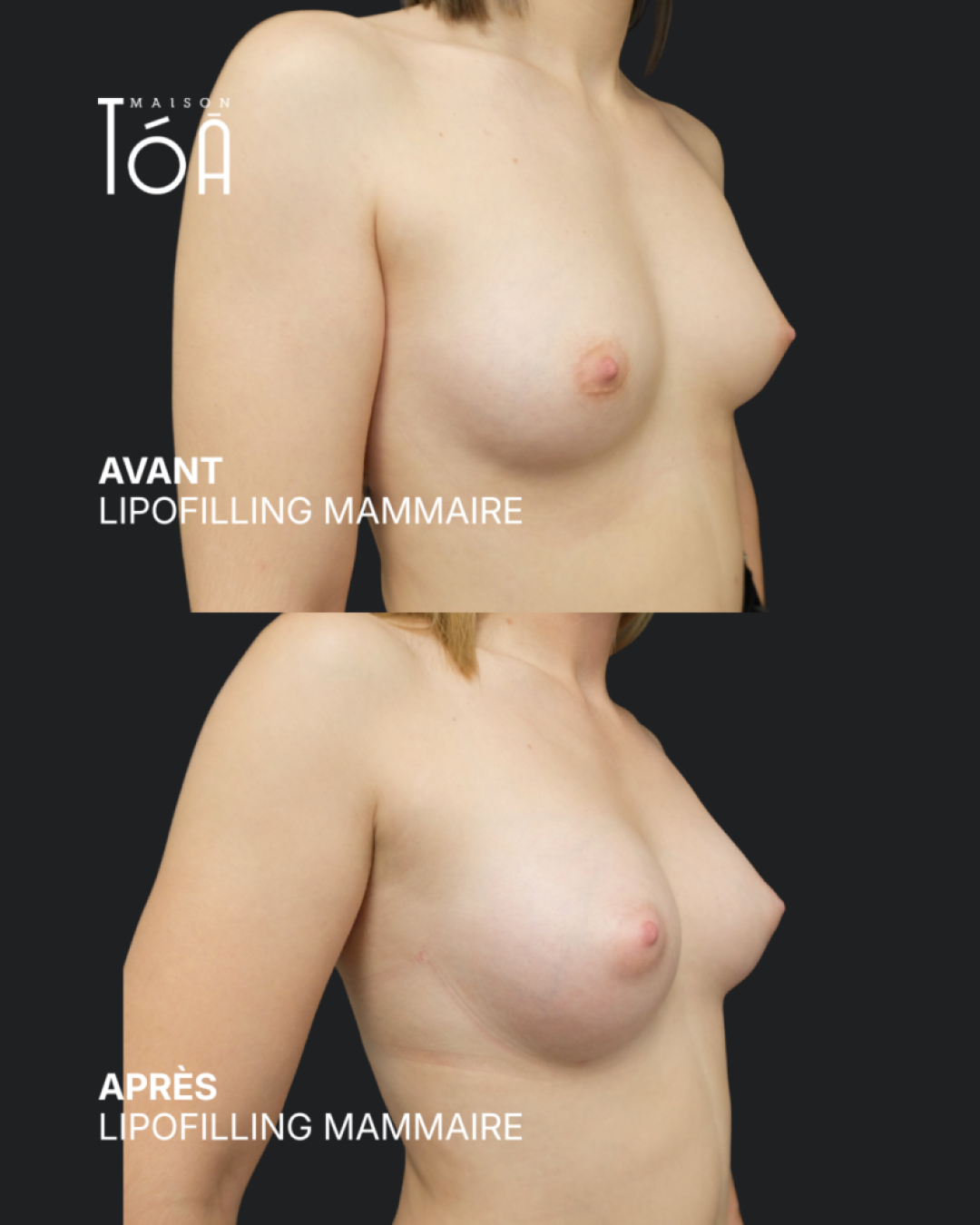 Breast lipofilling 5 Breast lipofilling before/after, result 1, Maison Tóā Lausanne