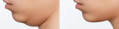 Double_chin