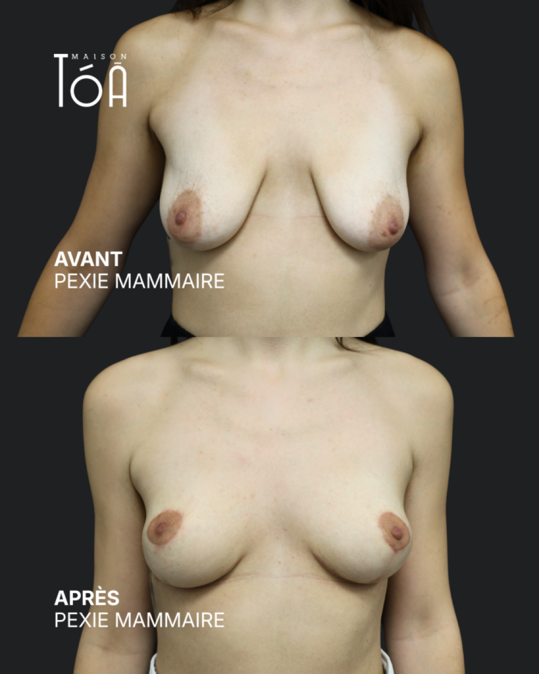 Breast lift before/after, result 3, Maison Tóā Lausanne
