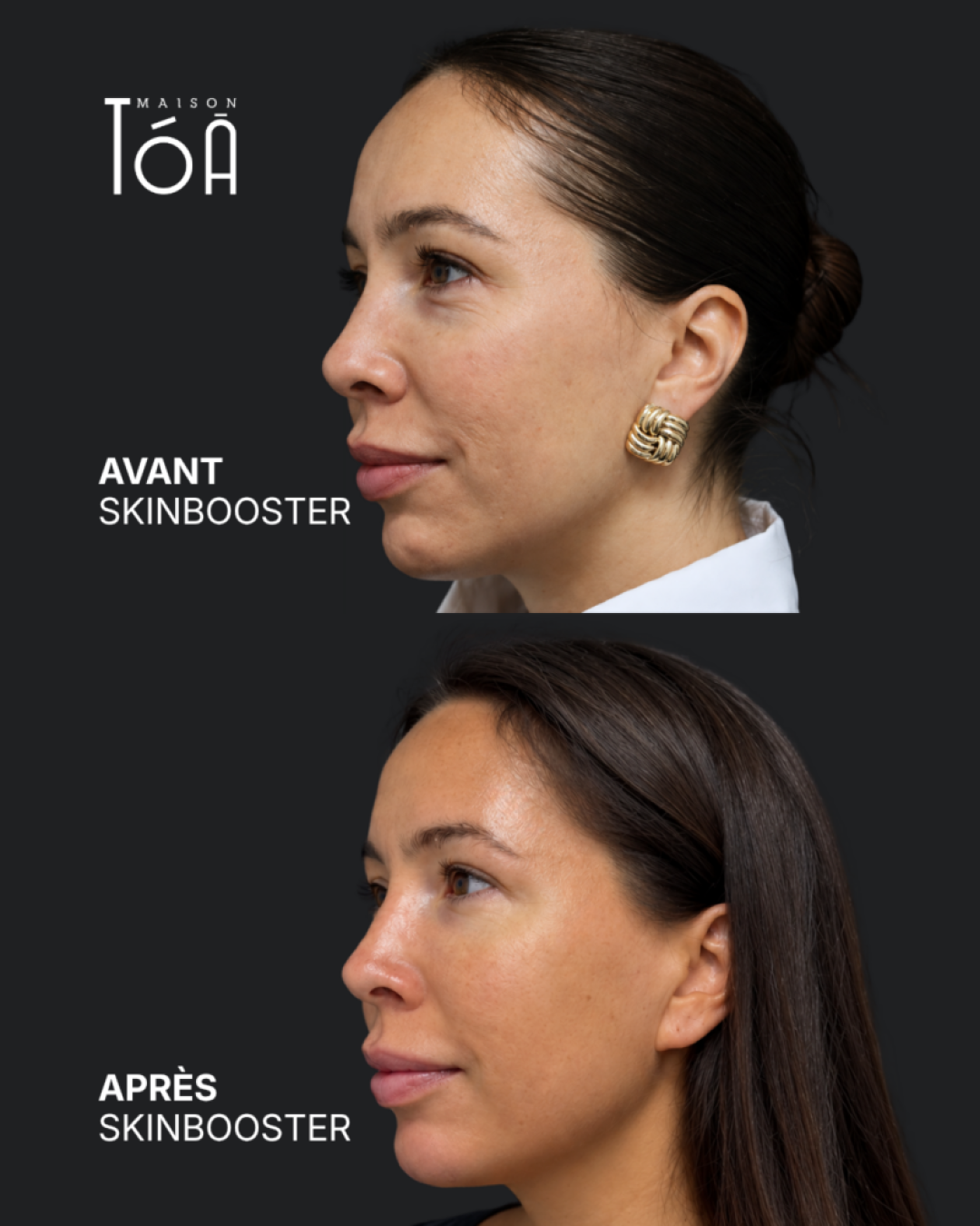 Skinbooster avant / après — cas 3, Maison Tóā Lausanne