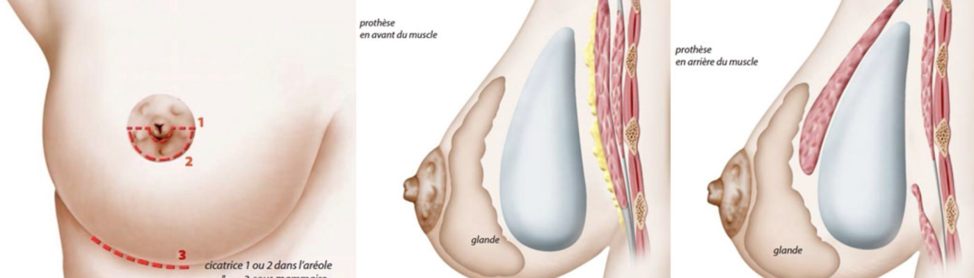 augmentation mammaire devant ou derriere le muscle