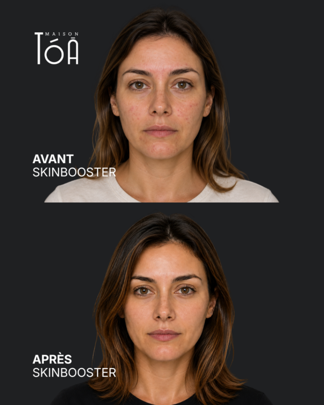 Skinbooster avant / après — cas 2, Maison Tóā Lausanne