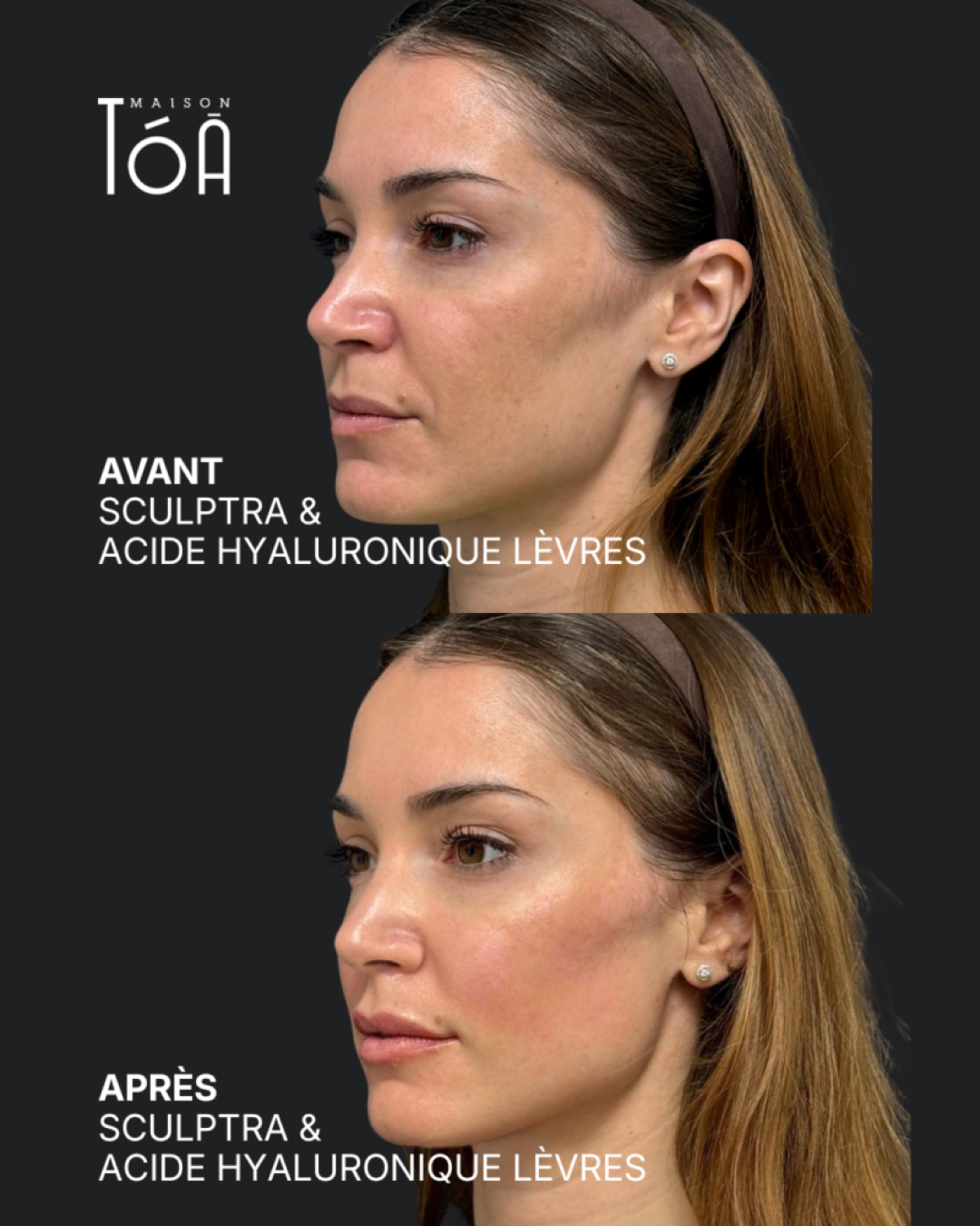 Sculptra 5 sculptra Après profhilo