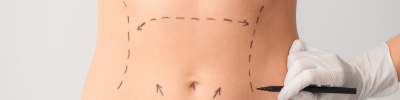 abdominoplastie