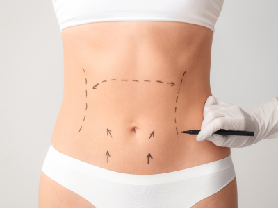 abdominoplatie