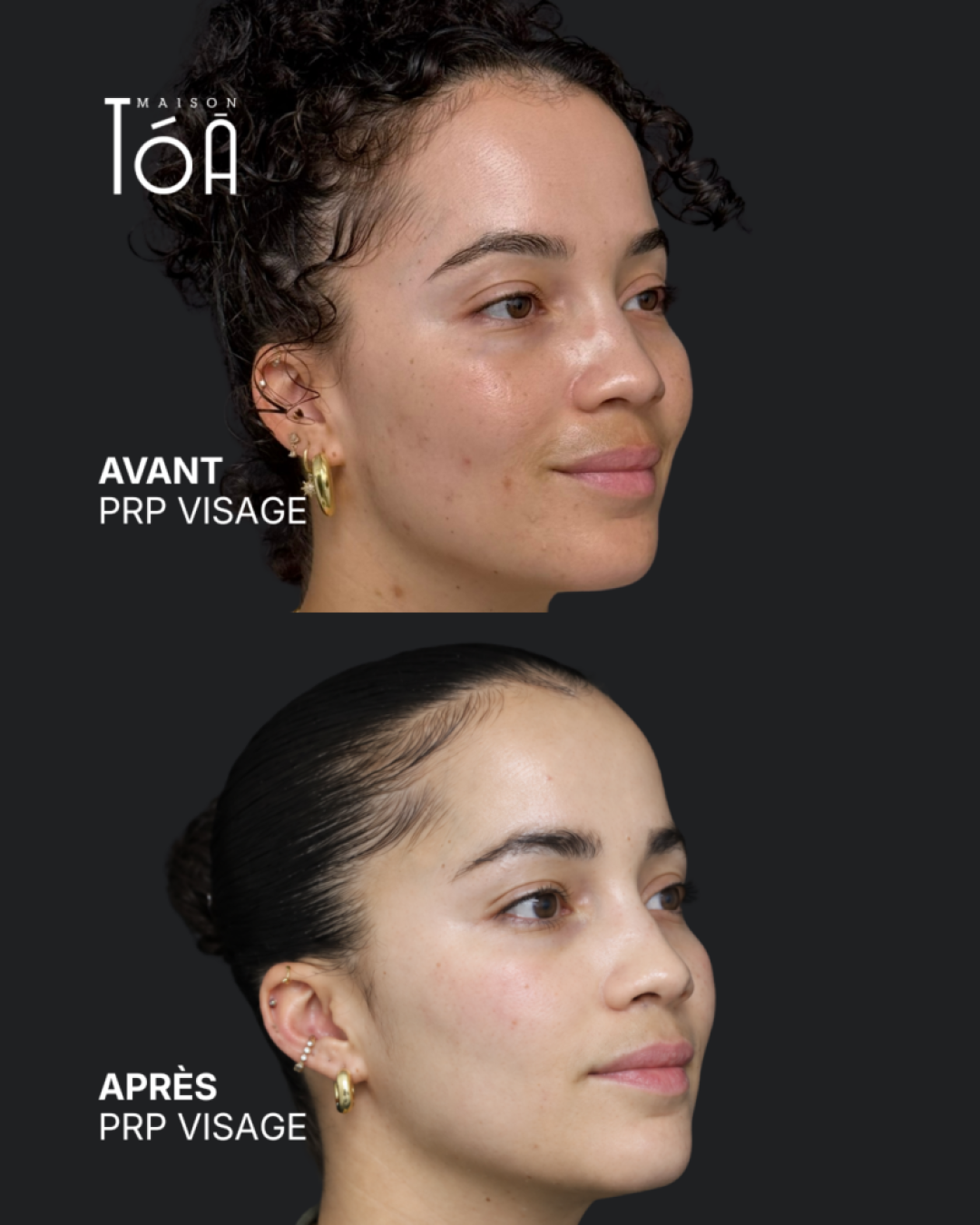 PRP visage avant après