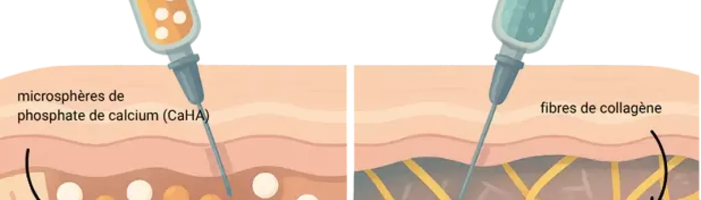 Sculptra vs radiesse