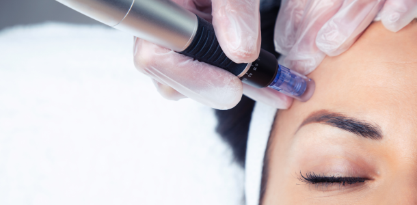 Acide Hyaluronique 76 microneedling