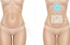 liposuccion vs coolsculpting 1