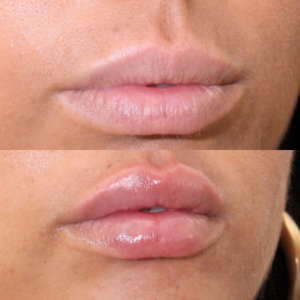 injection levre russian lips