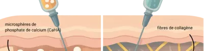 Sculptra vs radiesse