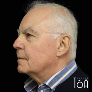 laser vasulaire lausanne