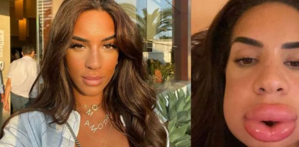 danger acide hyaluronique