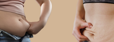 Liposuccion vs abdominoplastie