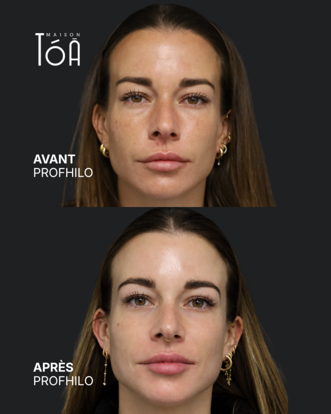 Profhilo® 5 Avant Après profhilo