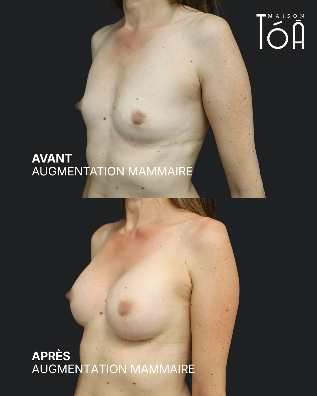 Avant Après augmentation mammaire