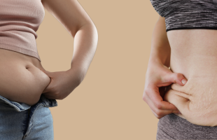 Liposuccion vs abdominoplastie