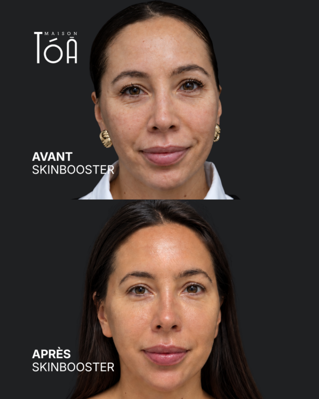 Skinbooster 6 Skinbooster avant / après — cas 3, Maison Tóā Lausanne