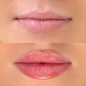 injection russian lips