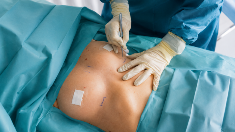 Breast lift surgery in the operating theatre, Maison Tóā Lausanne