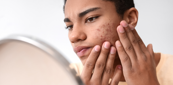 Acide Hyaluronique 93 Acne
