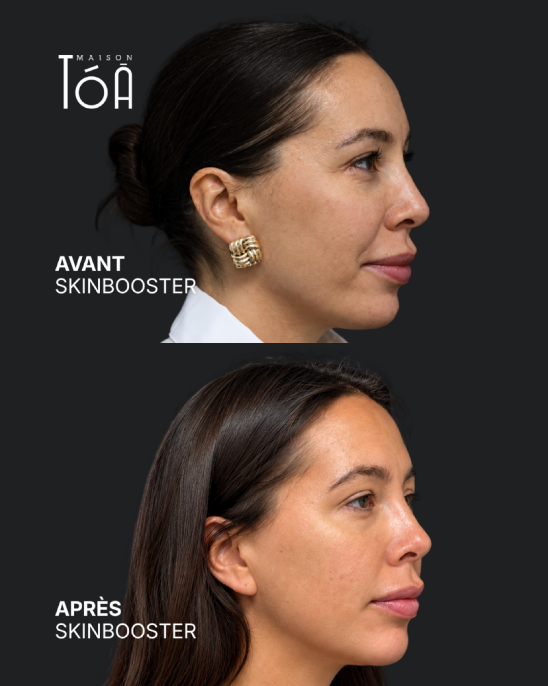 Skinbooster avant / après — cas 2, Maison Tóā Lausanne