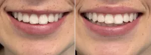 lip flip