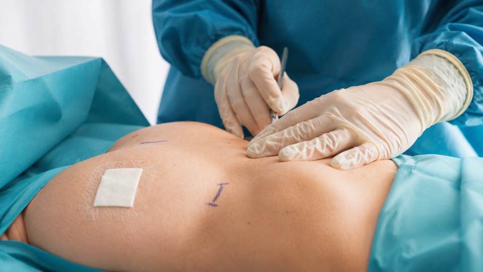 Breast lipofilling 3 Breast lipofilling procedure in the operating theatre, Maison Tóā Lausanne