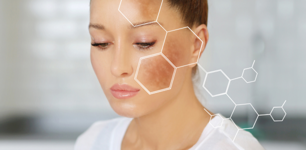 Acide Hyaluronique 90 Melasma